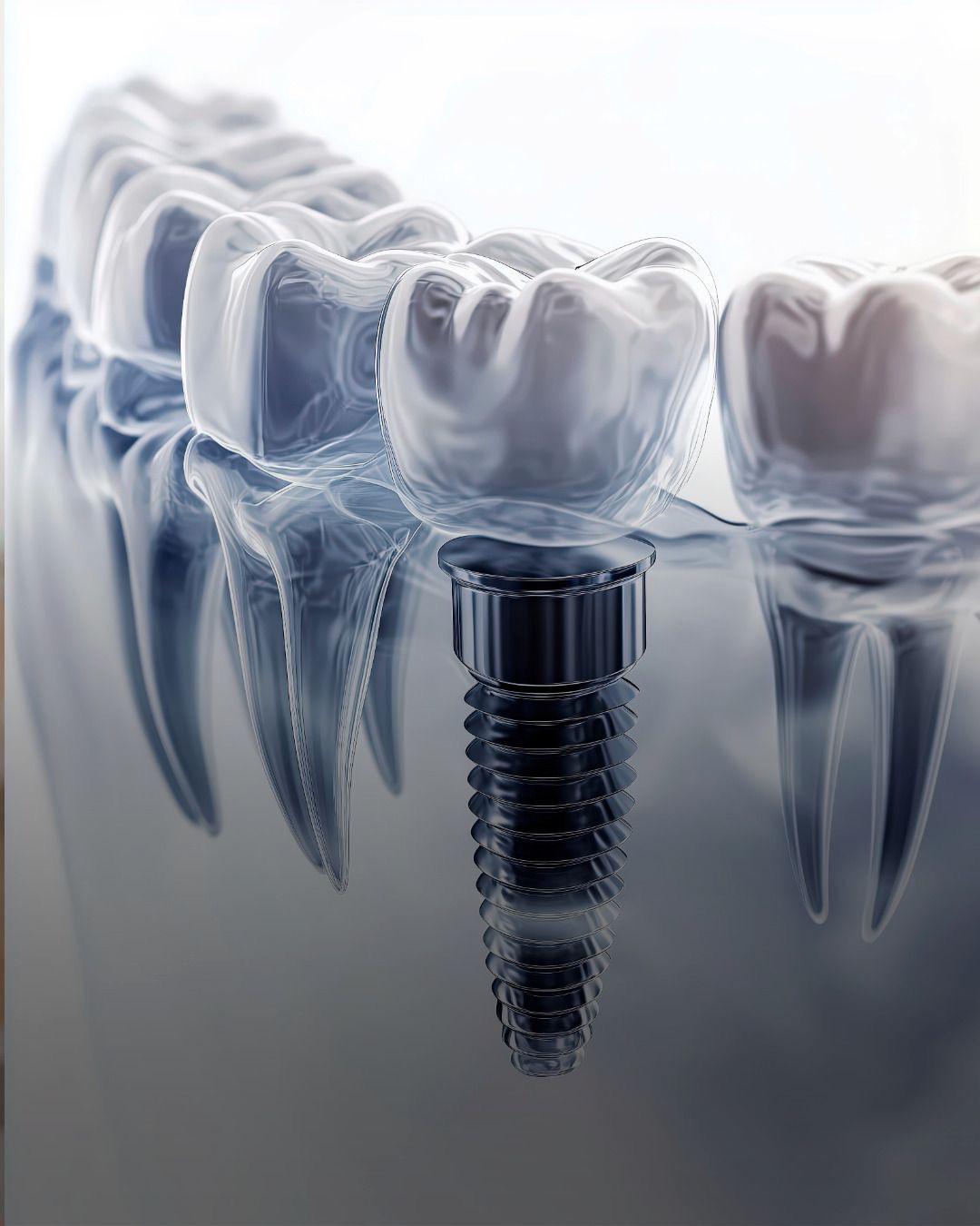 Fogászati implantátumok